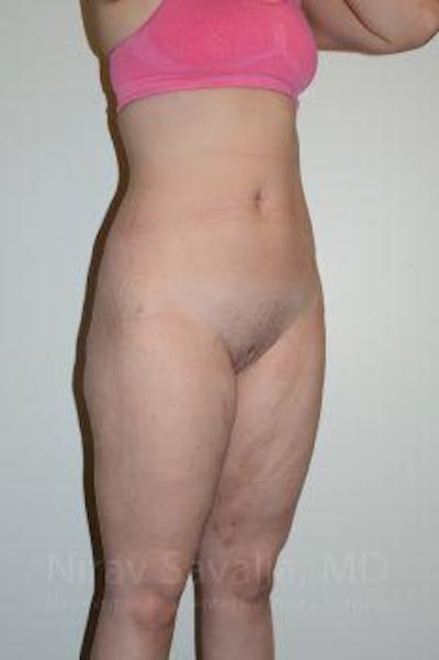 Liposuction Gallery - Patient 1655629 - Image 12