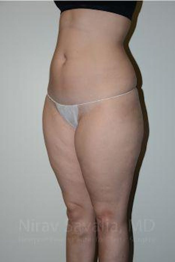 Liposuction Before & After Gallery - Patient 1655629 - Image 13