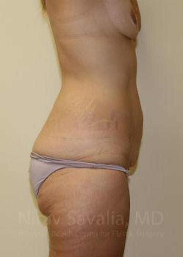 Abdominoplasty / Tummy Tuck Before & After Gallery - Patient 1655631 - Image 9