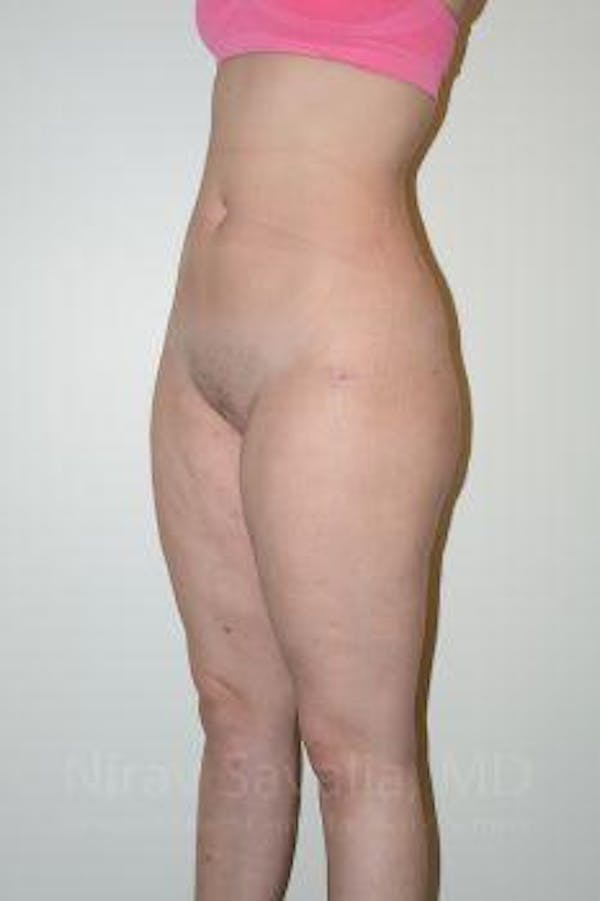 Liposuction Before & After Gallery - Patient 1655629 - Image 14