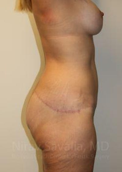 Abdominoplasty / Tummy Tuck Before & After Gallery - Patient 1655631 - Image 10
