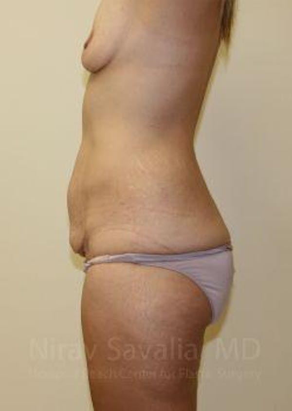 Mommy Makeover Gallery - Patient 1655630 - Image 9