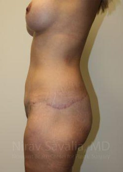 Abdominoplasty / Tummy Tuck Gallery - Patient 1655631 - Image 12