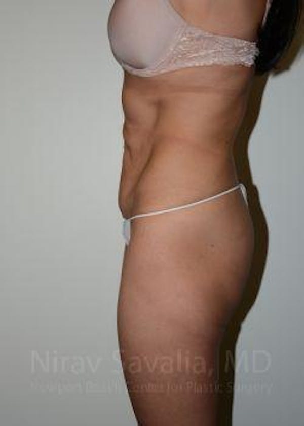 Body Contouring after Weight Loss Before & After Gallery - Patient 1655633 - Image 5