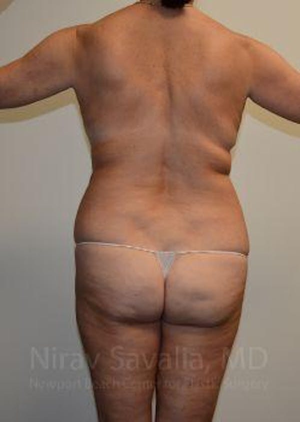Mommy Makeover Before & After Gallery - Patient 1655635 - Image 3