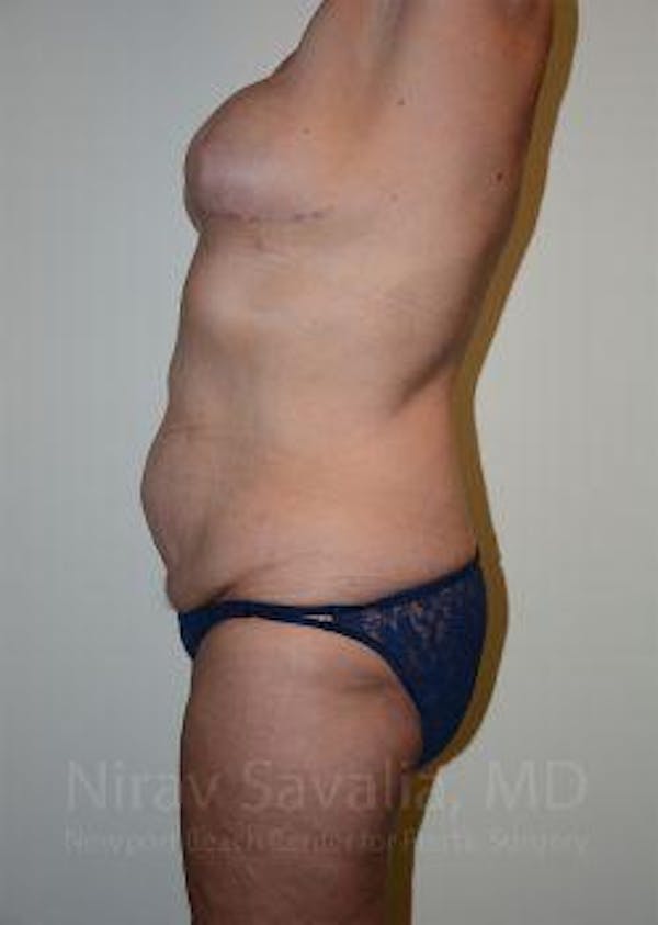 Abdominoplasty / Tummy Tuck Before & After Gallery - Patient 1655634 - Image 3
