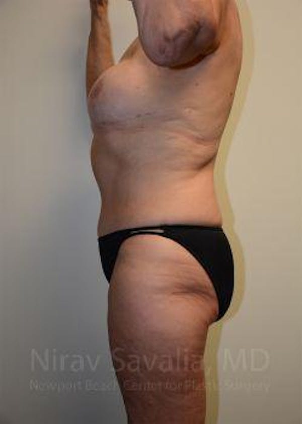 Abdominoplasty / Tummy Tuck Before & After Gallery - Patient 1655634 - Image 4