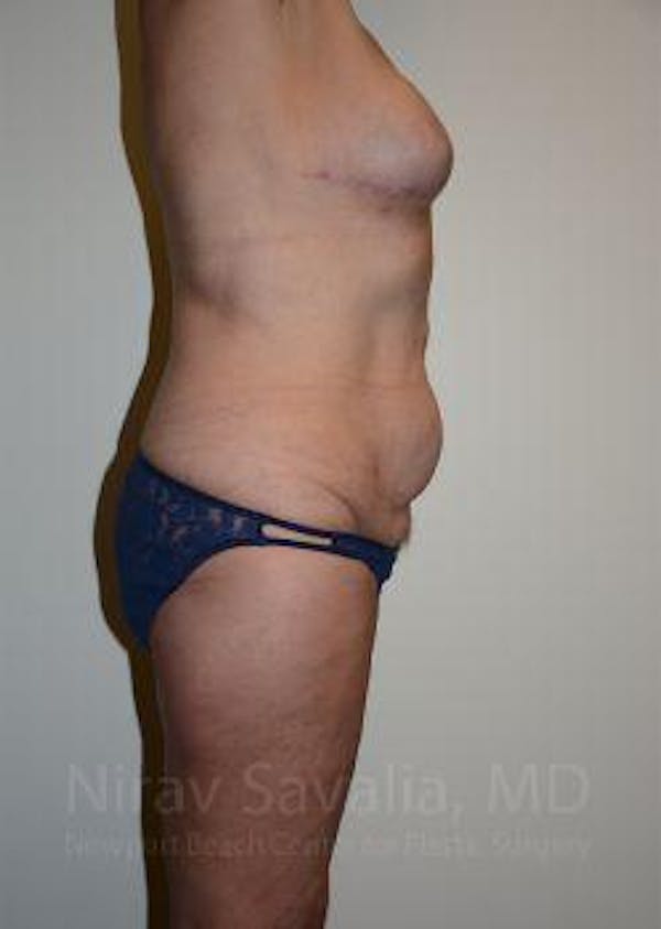 Abdominoplasty / Tummy Tuck Before & After Gallery - Patient 1655634 - Image 5