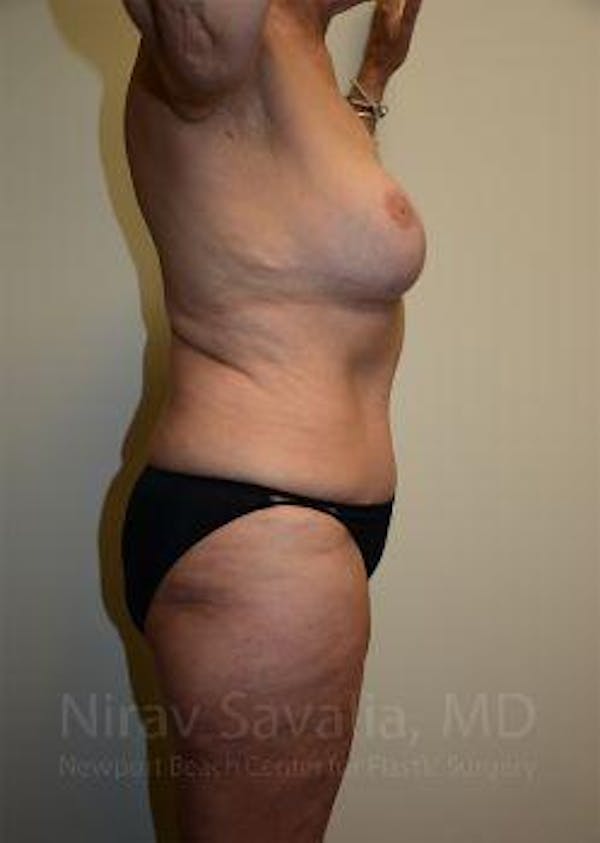 Abdominoplasty / Tummy Tuck Before & After Gallery - Patient 1655634 - Image 6