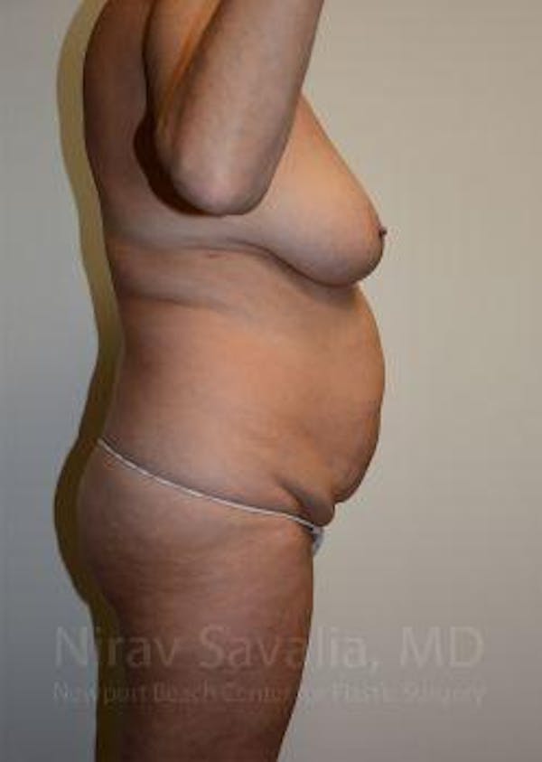 Mommy Makeover Before & After Gallery - Patient 1655635 - Image 7