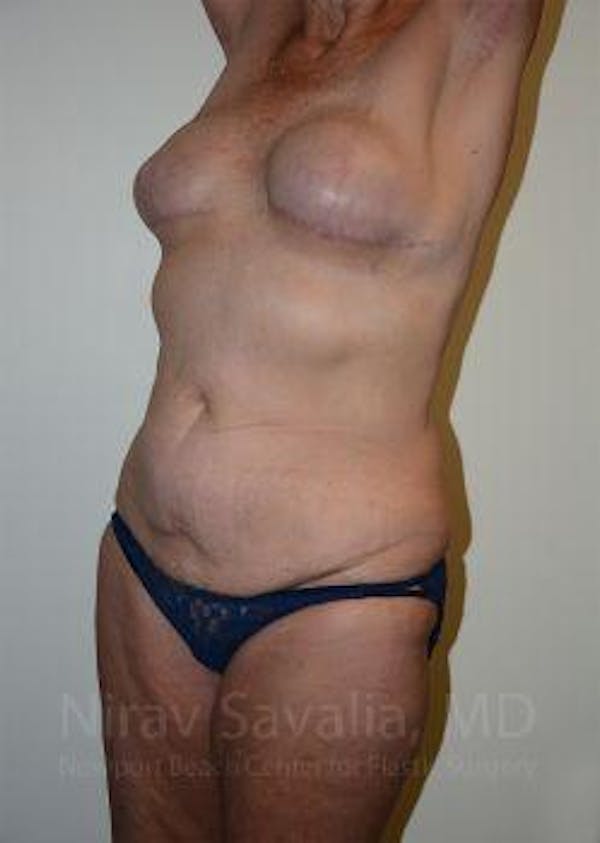 Abdominoplasty / Tummy Tuck Before & After Gallery - Patient 1655634 - Image 7