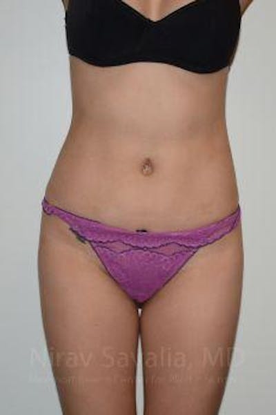 Liposuction Before & After Gallery - Patient 1655637 - Image 2