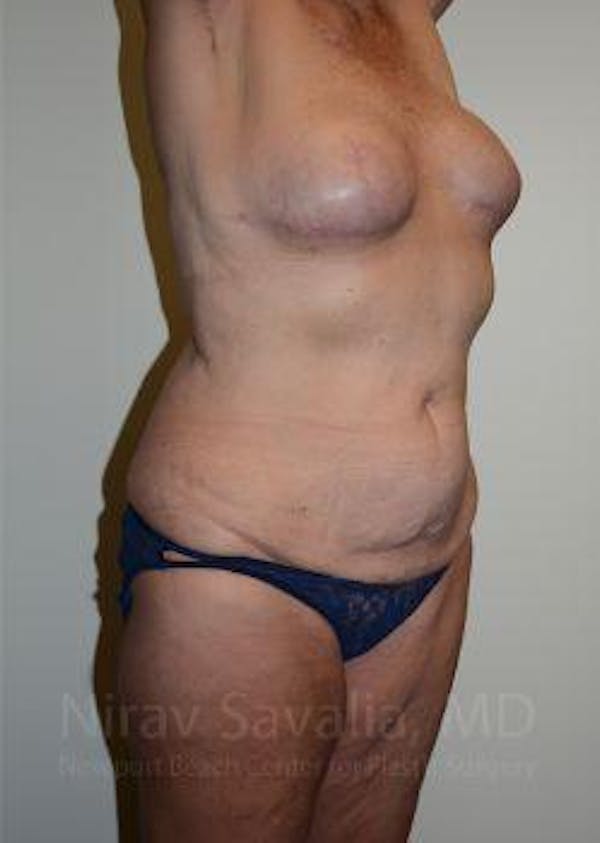Abdominoplasty / Tummy Tuck Before & After Gallery - Patient 1655634 - Image 9