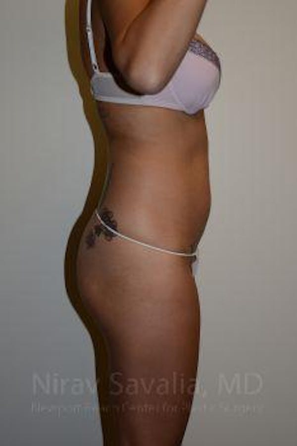 Liposuction Before & After Gallery - Patient 1655637 - Image 3