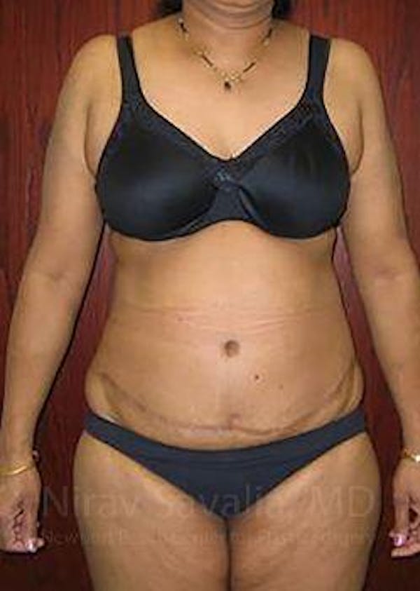 Body Contouring after Weight Loss Before & After Gallery - Patient 1655636 - Image 2