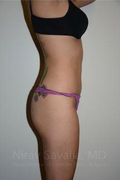 Liposuction Before & After Gallery - Patient 1655637 - Image 4