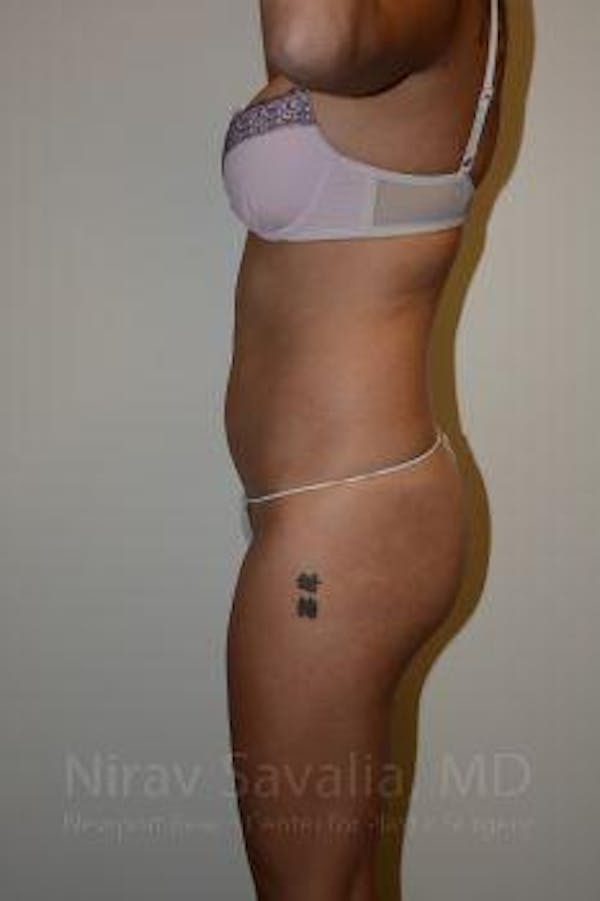 Liposuction Before & After Gallery - Patient 1655637 - Image 5