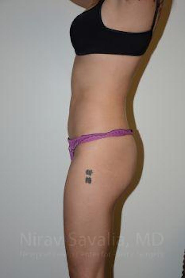 Liposuction Gallery - Patient 1655637 - Image 6