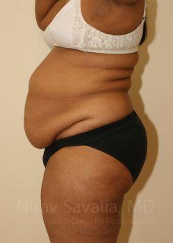Body Contouring after Weight Loss Before & After Gallery - Patient 1655636 - Image 5