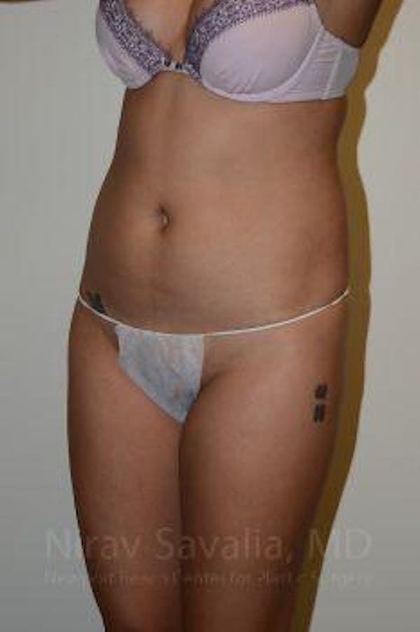 Liposuction Gallery - Patient 1655637 - Image 9
