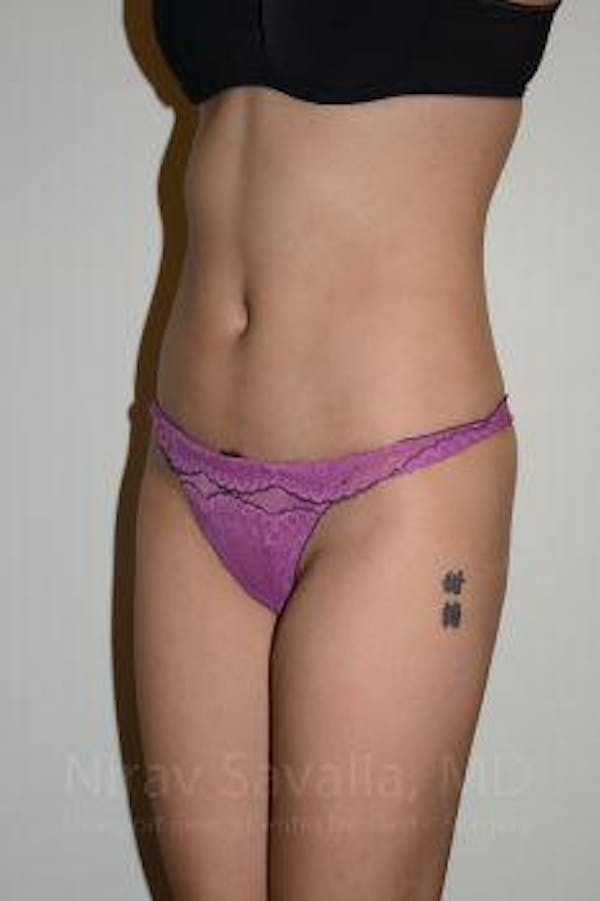 Liposuction Before & After Gallery - Patient 1655637 - Image 8