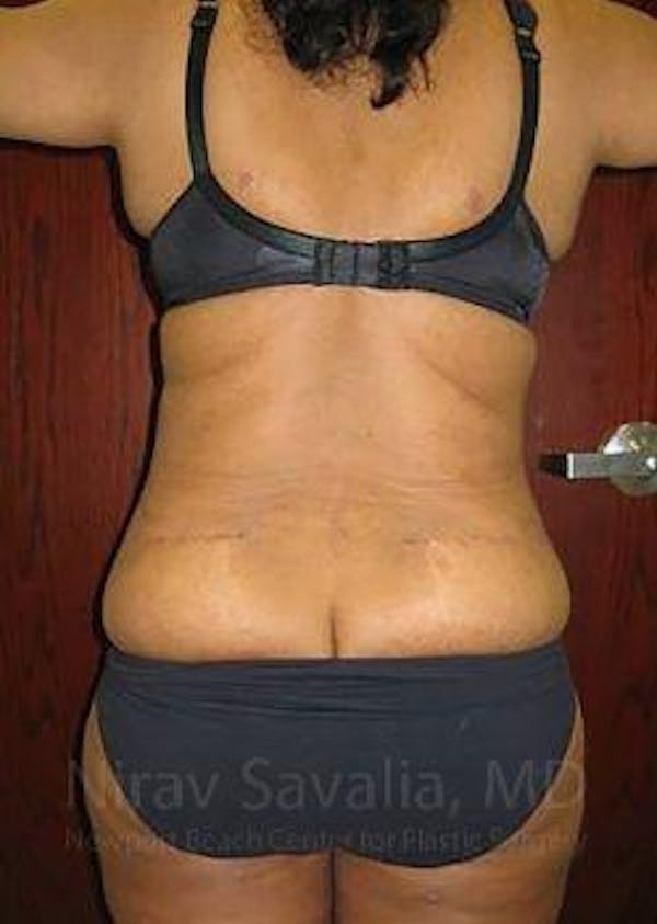 Body Contouring after Weight Loss Before & After Gallery - Patient 1655636 - Image 8