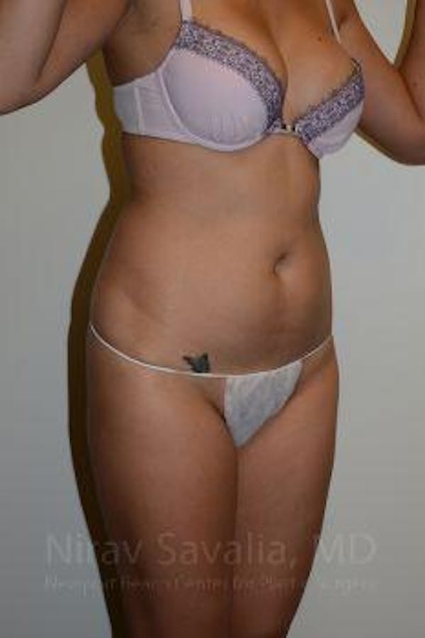 Liposuction Before & After Gallery - Patient 1655637 - Image 9