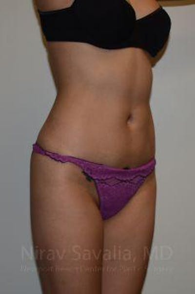 Liposuction Before & After Gallery - Patient 1655637 - Image 10