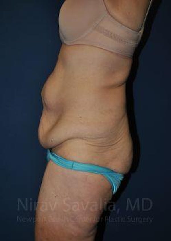 Abdominoplasty / Tummy Tuck Gallery - Patient 1655638 - Image 5