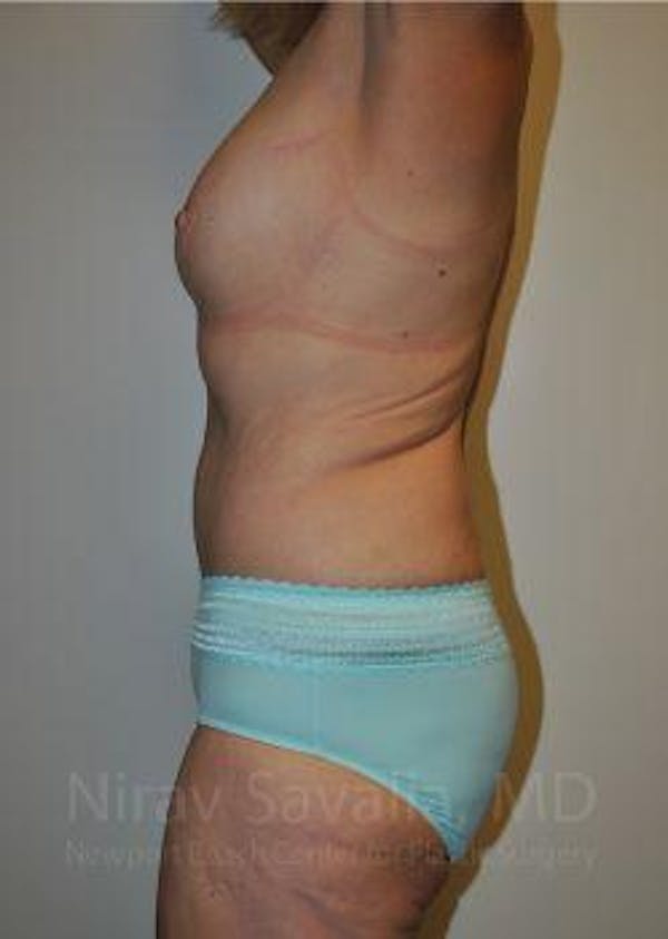 Abdominoplasty / Tummy Tuck Before & After Gallery - Patient 1655638 - Image 6