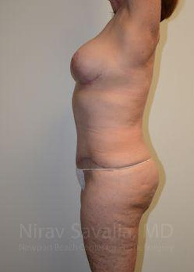 Mommy Makeover Gallery - Patient 1655639 - Image 6