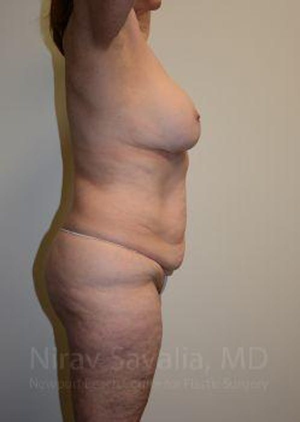 Mommy Makeover Gallery - Patient 1655639 - Image 7