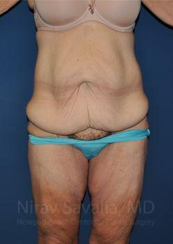Body Contouring after Weight Loss Before & After Gallery - Patient 1655640 - Image 1