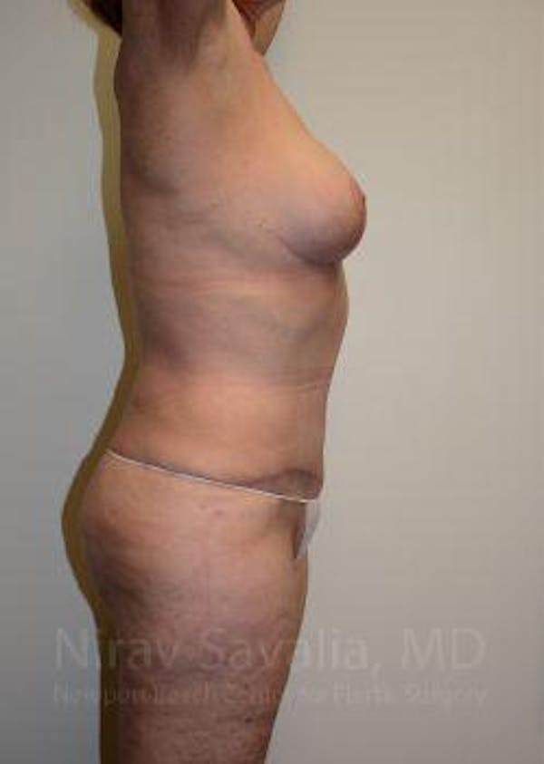Mommy Makeover Gallery - Patient 1655639 - Image 8