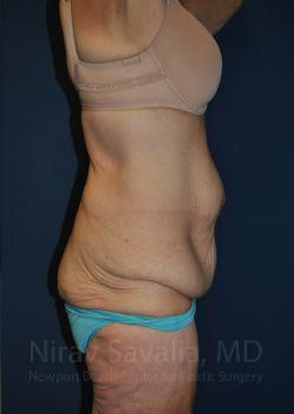 Body Contouring after Weight Loss Before & After Gallery - Patient 1655640 - Image 3
