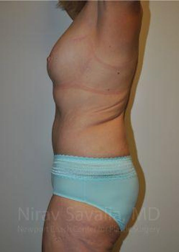 Body Contouring after Weight Loss Before & After Gallery - Patient 1655640 - Image 6