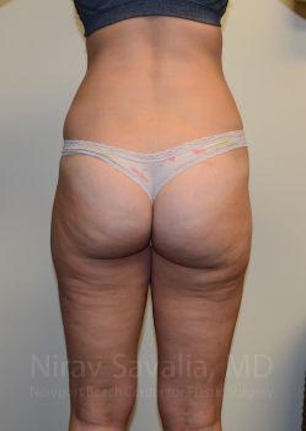 Liposuction Before & After Gallery - Patient 1655642 - Image 4