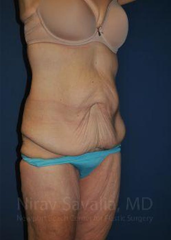 Body Contouring after Weight Loss Before & After Gallery - Patient 1655640 - Image 7