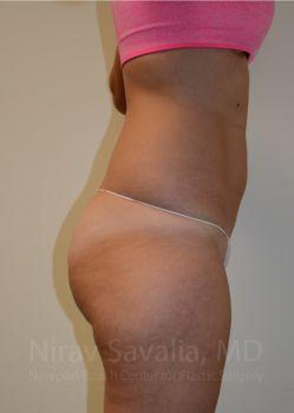 Liposuction Before & After Gallery - Patient 1655642 - Image 5