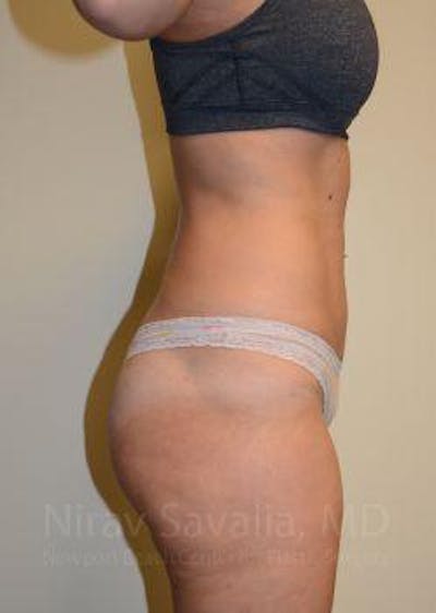 Liposuction Before & After Gallery - Patient 1655642 - Image 6
