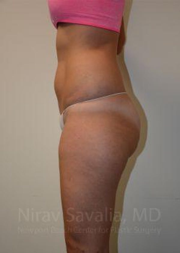 Liposuction Before & After Gallery - Patient 1655642 - Image 7