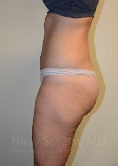 Liposuction Before & After Gallery - Patient 1655642 - Image 8