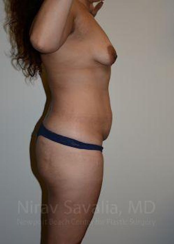 Abdominoplasty / Tummy Tuck Gallery - Patient 1655641 - Image 5
