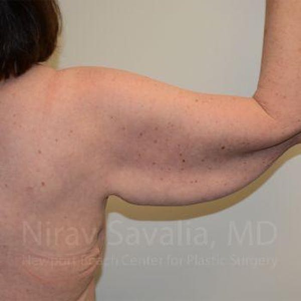 Body Contouring after Weight Loss Gallery - Patient 1655643 - Image 1