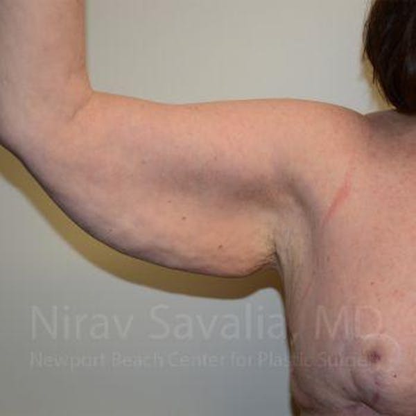 Body Contouring after Weight Loss Before & After Gallery - Patient 1655643 - Image 3