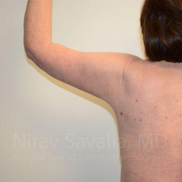 Body Contouring after Weight Loss Before & After Gallery - Patient 1655643 - Image 8