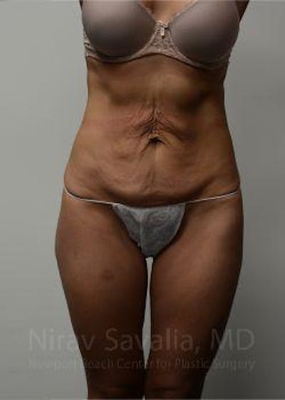 Abdominoplasty / Tummy Tuck Before & After Gallery - Patient 1655645 - Image 1