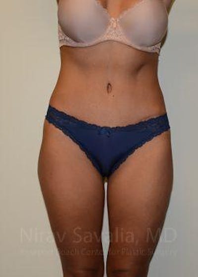 Abdominoplasty / Tummy Tuck Before & After Gallery - Patient 1655645 - Image 2