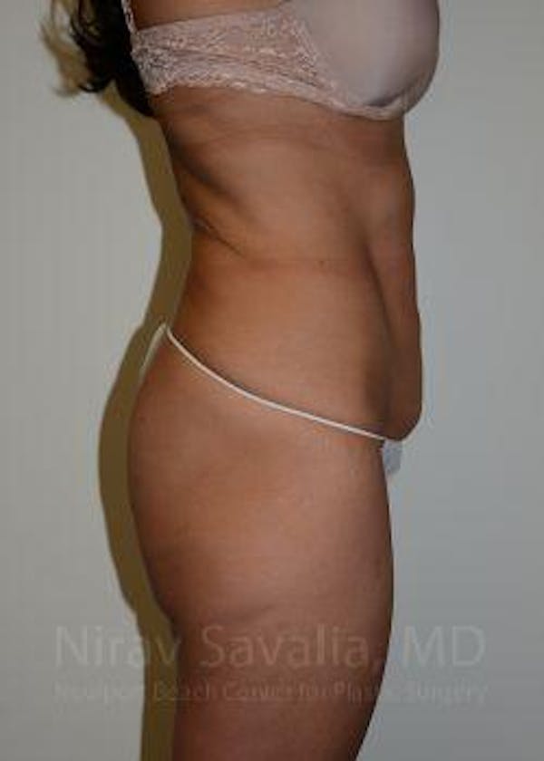 Abdominoplasty / Tummy Tuck Gallery - Patient 1655645 - Image 3