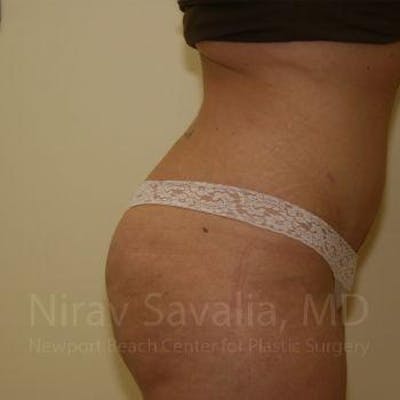 Liposuction Before & After Gallery - Patient 1655647 - Image 4